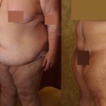 Tummy Tuck (Abdominoplasty) Super Plus Size Before & After Patient #12677