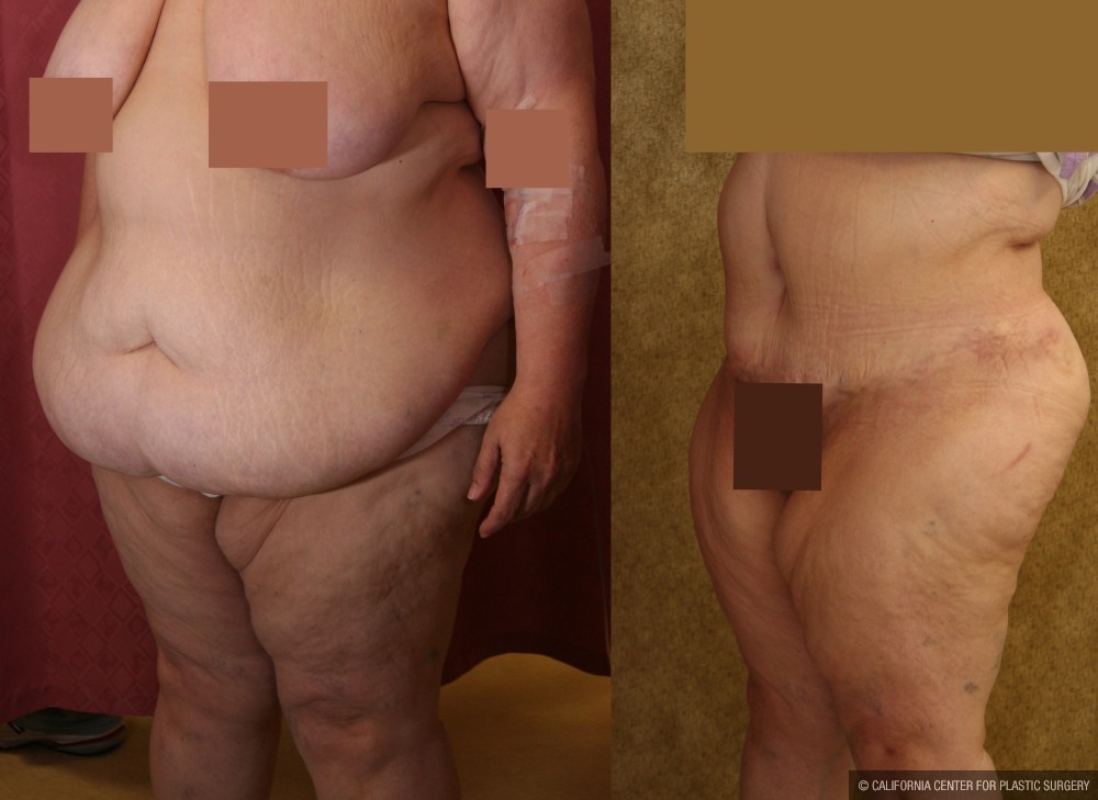 Tummy Tuck (Abdominoplasty) Super Plus Size Before & After Patient #12677