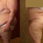 Tummy Tuck (Abdominoplasty) Super Plus Size Before & After Patient #12677