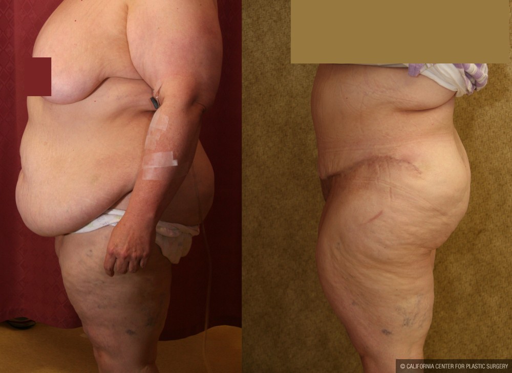 Tummy Tuck (Abdominoplasty) Super Plus Size Before & After Patient #12677