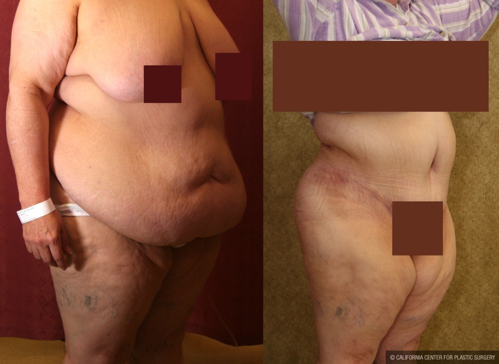 Tummy Tuck (Abdominoplasty) Super Plus Size Before & After Patient #12677