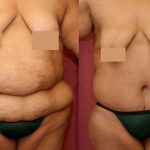 Tummy Tuck (Abdominoplasty) Super Plus Size Before & After Patient #12717