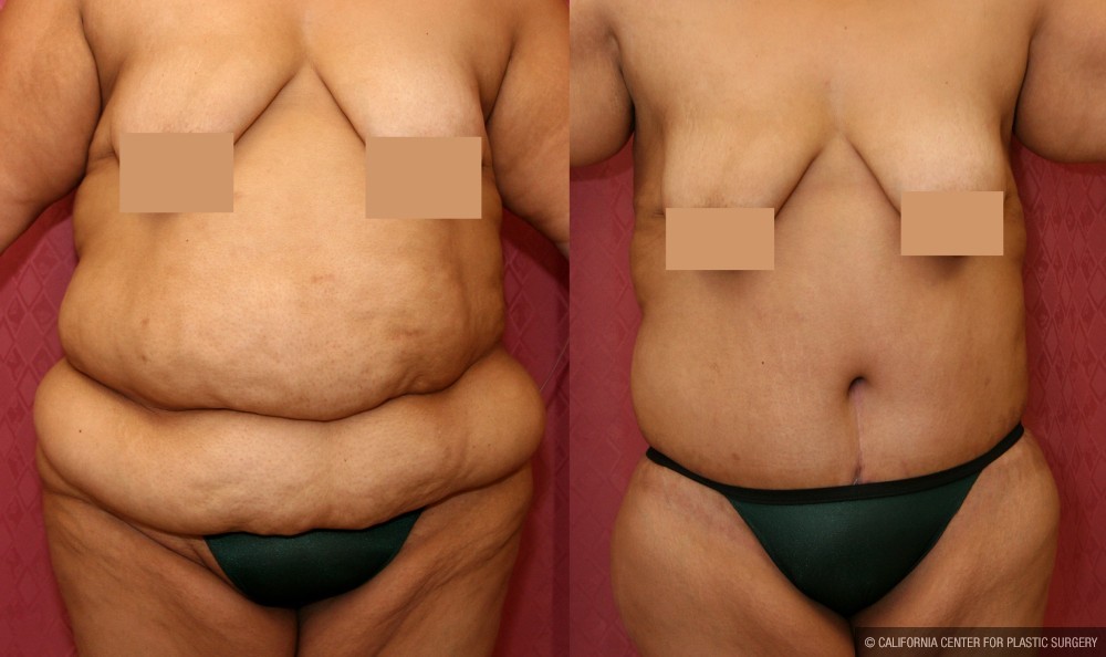 Tummy Tuck (Abdominoplasty) Super Plus Size Before & After Patient #12717