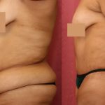 Tummy Tuck (Abdominoplasty) Super Plus Size Before & After Patient #12717