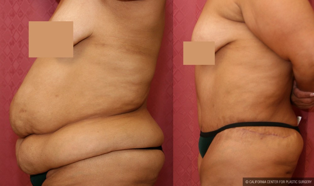 Tummy Tuck (Abdominoplasty) Super Plus Size Before & After Patient #12717