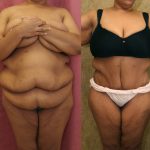 Tummy Tuck (Abdominoplasty) Super Plus Size Before & After Patient #12712