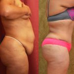 Tummy Tuck (Abdominoplasty) Medium Size Before & After Patient #12622