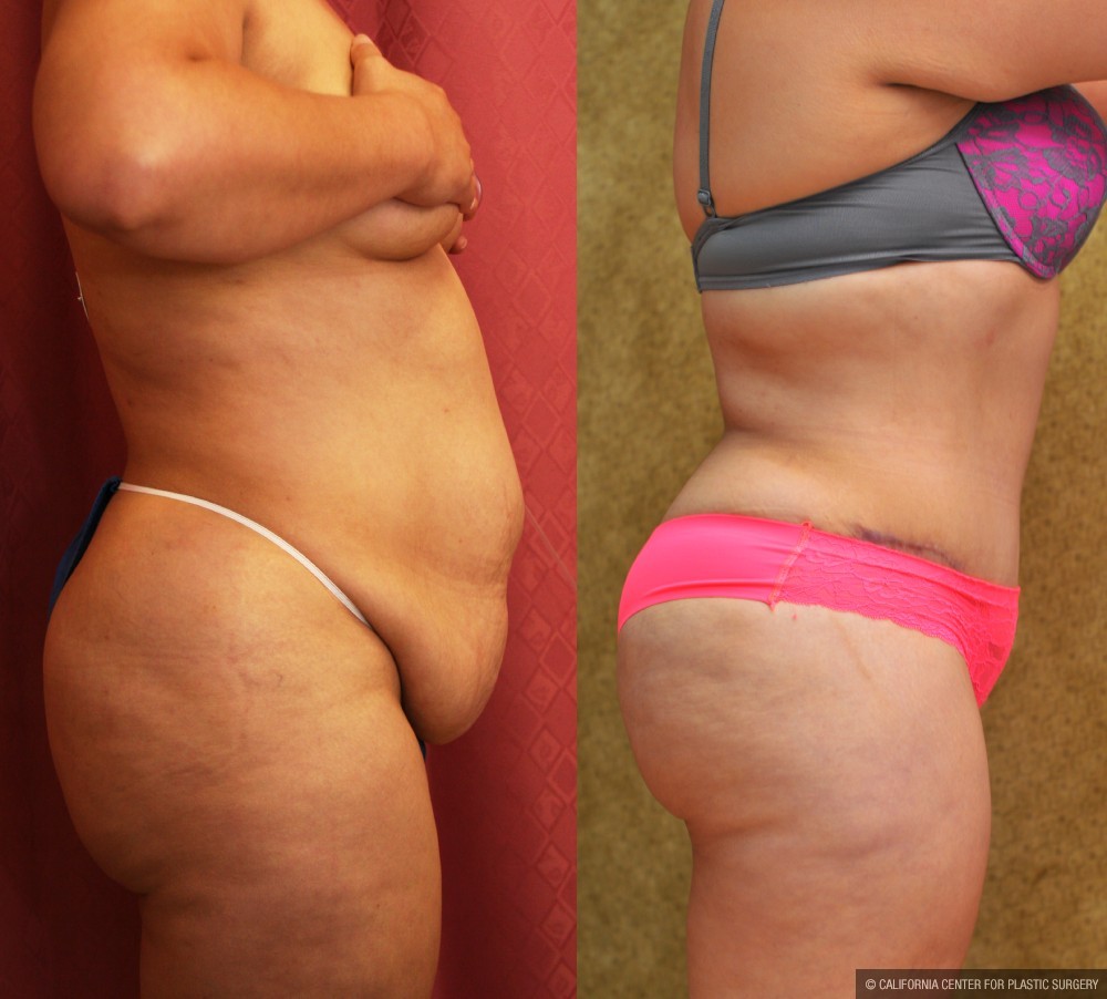 Tummy Tuck (Abdominoplasty) Medium Size Before & After Patient #12622
