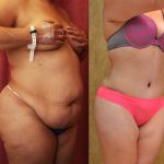 Tummy Tuck (Abdominoplasty) Medium Size Before & After Patient #12622