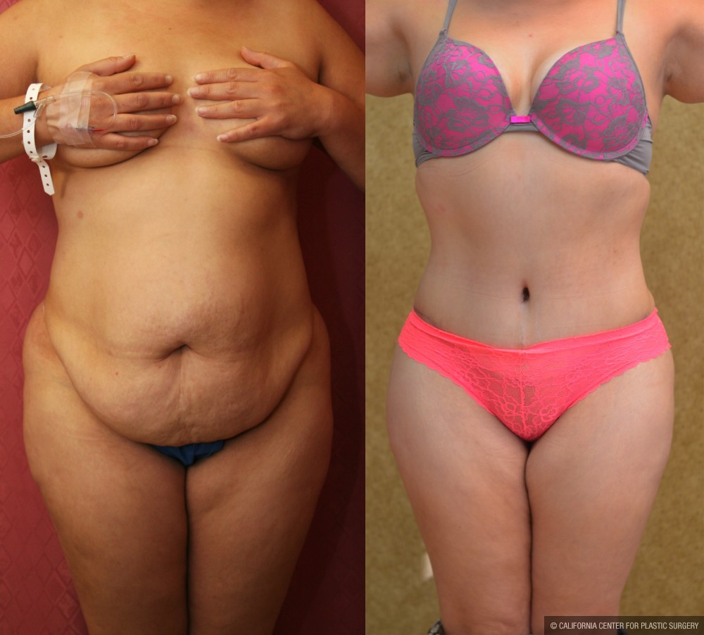 Tummy Tuck (Abdominoplasty) Medium Size Before & After Patient #12622