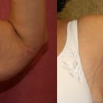 Arm Lift (Brachioplasty) Before & After Patient #12737