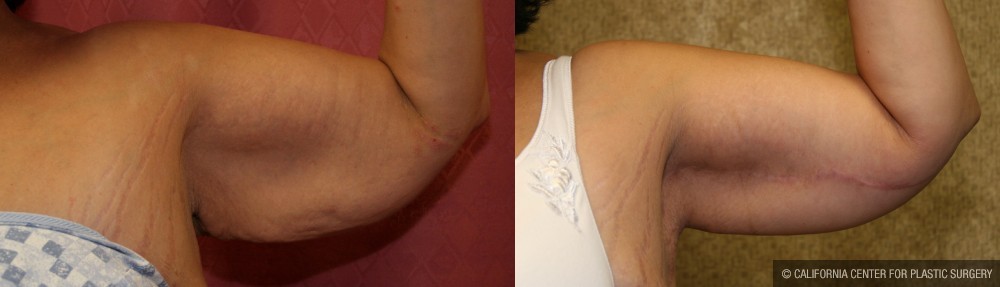 Arm Lift (Brachioplasty) Before & After Patient #12737