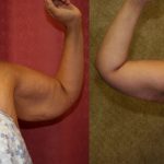 Arm Lift (Brachioplasty) Before & After Patient #12737