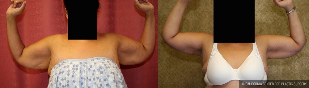 Arm Lift (Brachioplasty) Before & After Patient #12737