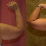 Arm Lift (Brachioplasty) Before & After Patient #12737