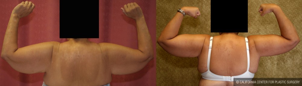 Arm Lift (Brachioplasty) Before & After Patient #12737