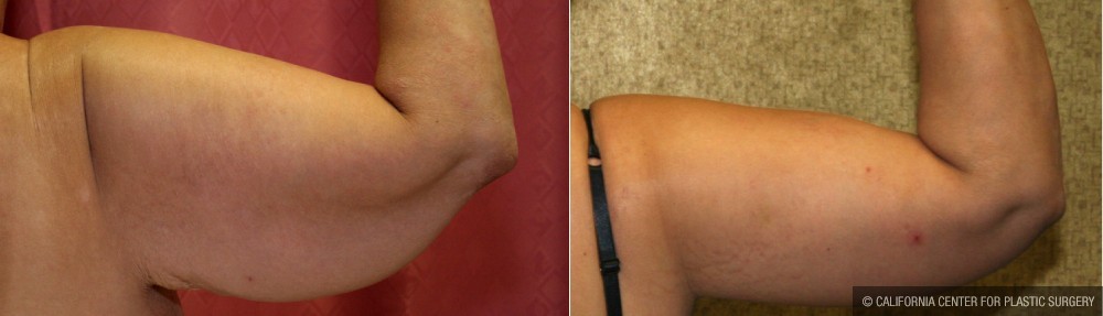 Arm Lift (Brachioplasty) Before & After Patient #12737