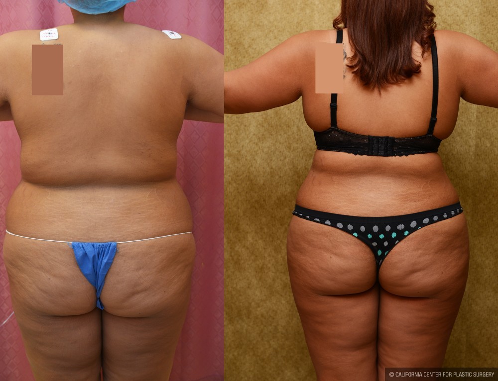 Liposuction Abdomen Plus Size Before & After Patient #12610