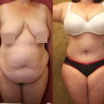 Tummy Tuck (Abdominoplasty) Super Plus Size Before & After Patient #12696