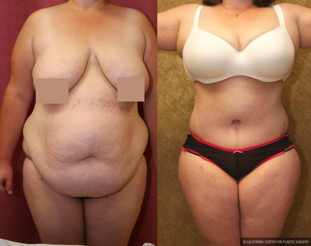 Tummy Tuck (Abdominoplasty) Super Plus Size Before & After Patient #12696