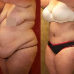 Tummy Tuck (Abdominoplasty) Super Plus Size Before & After Patient #12696