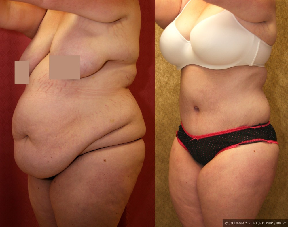Tummy Tuck (Abdominoplasty) Super Plus Size Before & After Patient #12696