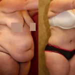 Tummy Tuck (Abdominoplasty) Super Plus Size Before & After Patient #12696