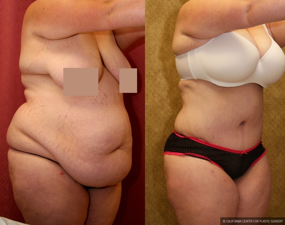 Tummy Tuck (Abdominoplasty) Super Plus Size Before & After Patient #12696