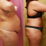 Liposuction Abdomen Plus Size Before & After Patient #12610