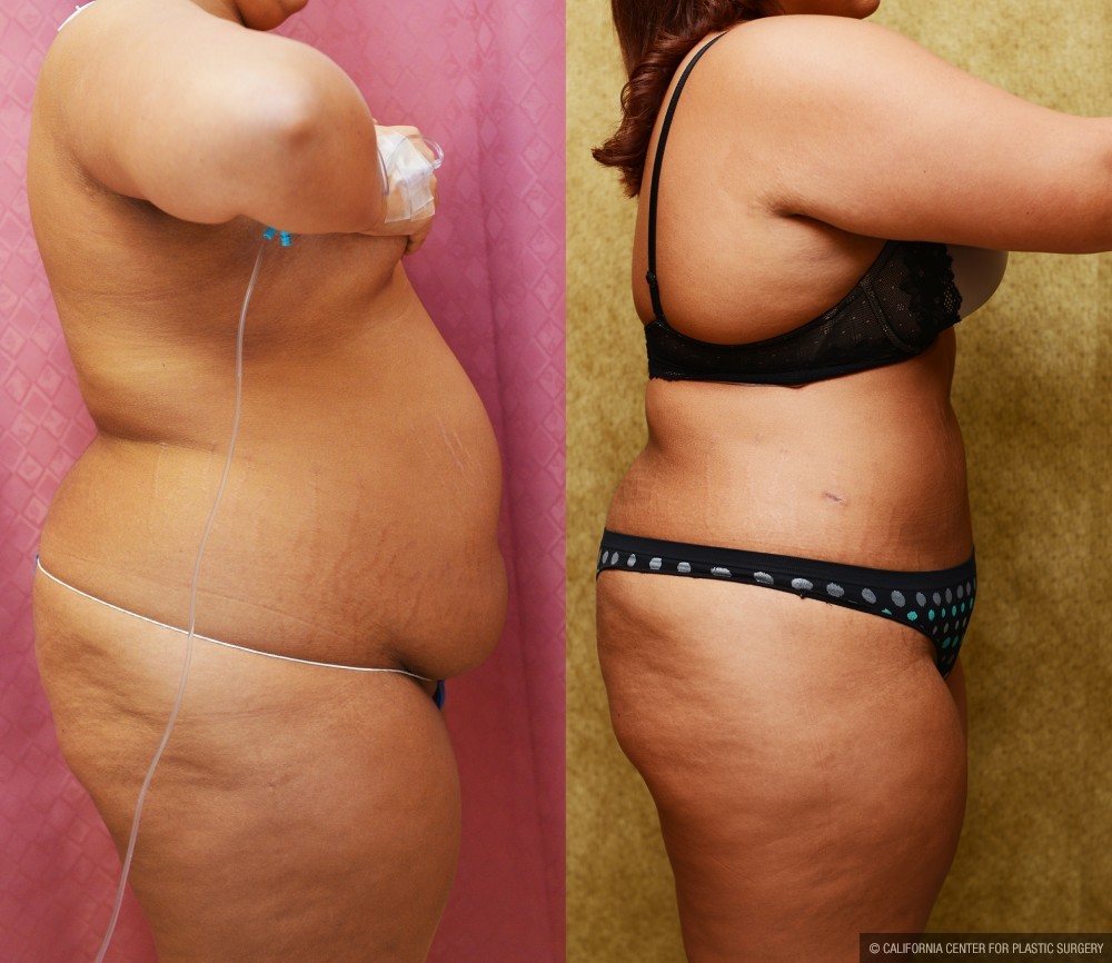 Liposuction Abdomen Plus Size Before & After Patient #12610