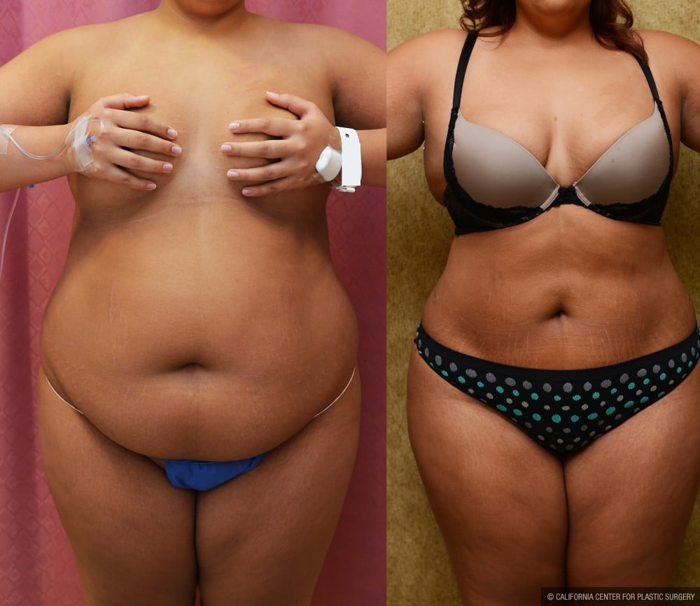 Liposuction Abdomen Plus Size Before & After Patient #12610