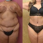 Tummy Tuck (Abdominoplasty) Super Plus Size Before & After Patient #12708