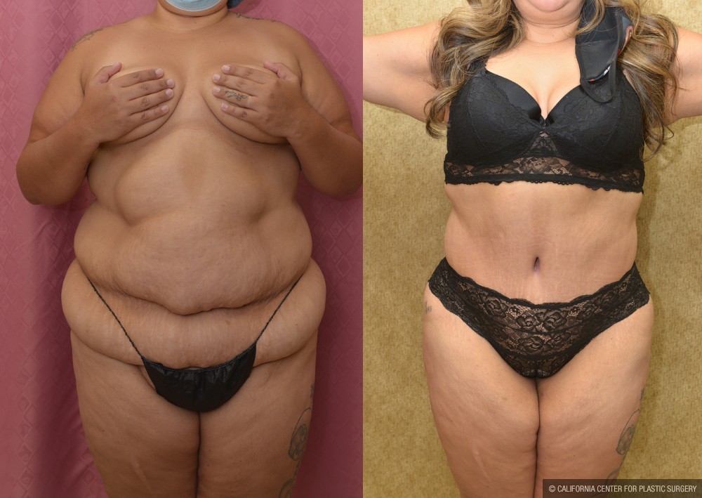 Tummy Tuck (Abdominoplasty) Super Plus Size Before & After Patient #12708