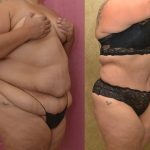 Tummy Tuck (Abdominoplasty) Super Plus Size Before & After Patient #12708