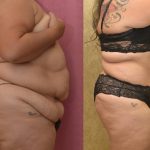 Tummy Tuck (Abdominoplasty) Super Plus Size Before & After Patient #12708