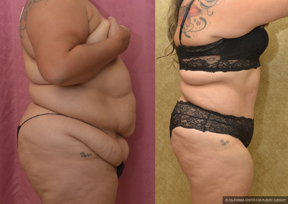 Tummy Tuck (Abdominoplasty) Super Plus Size Before & After Patient #12708