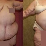 Tummy Tuck (Abdominoplasty) Super Plus Size Before & After Patient #12700