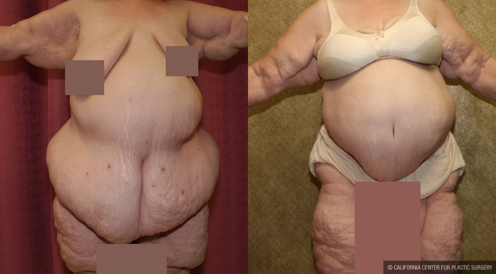 Tummy Tuck (Abdominoplasty) Super Plus Size Before & After Patient #12700