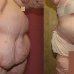 Tummy Tuck (Abdominoplasty) Super Plus Size Before & After Patient #12700