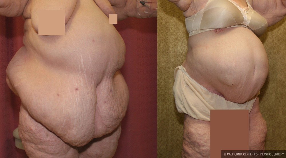 Tummy Tuck (Abdominoplasty) Super Plus Size Before & After Patient #12700