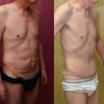 Male Tummy Tuck (abdominoplasty) Before & After Patient #12650