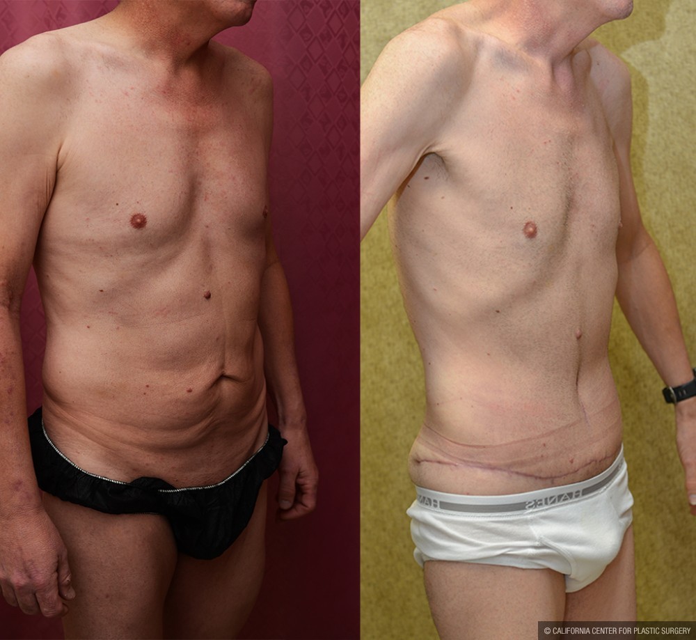 Male Tummy Tuck (abdominoplasty) Before & After Patient #12650