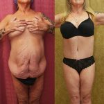 Patient #5874 Tummy Tuck (Abdominoplasty) Plus Size Before and