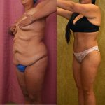 Body Lift Before & After Patient #12880