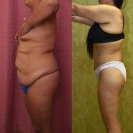 Body Lift Before & After Patient #12880