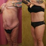 Body Lift Before & After Patient #12873