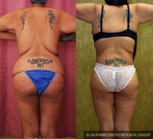 Body Lift Before & After Patient #12880