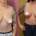 Body Lift Before & After Patient #12879