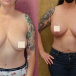 Breast Lift (Mastopexy) Before & After Patient #12879