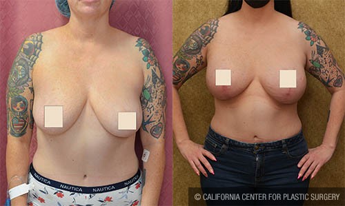 Breast Lift (Mastopexy) Before & After Patient #12879